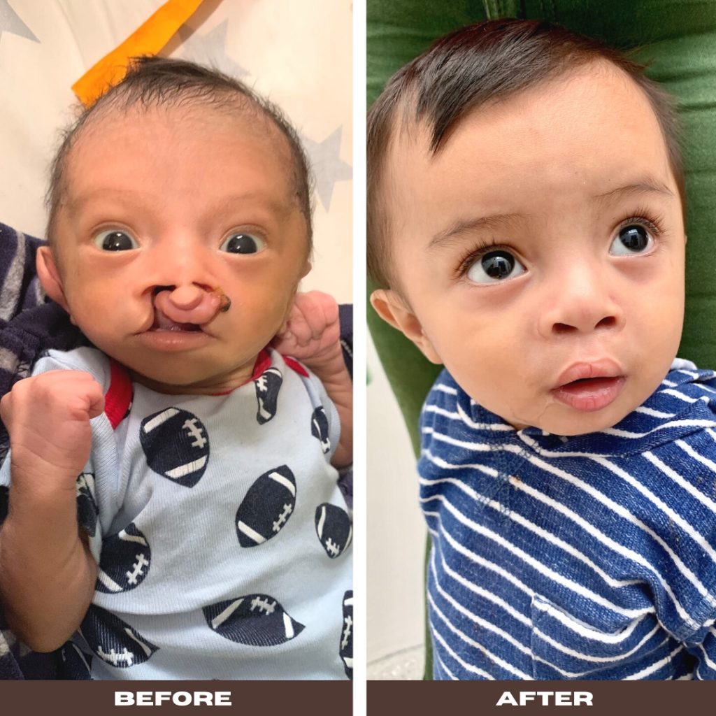 Tulipanes Hospital – Guatemala’s First Cleft Lip Hospital For The Poor